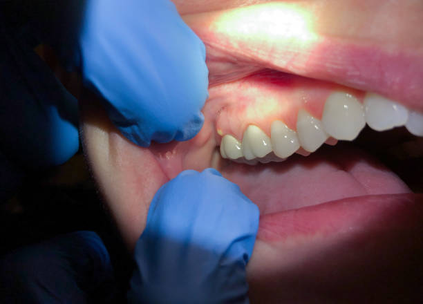 Best Urgent Tooth Repair  in Chisholm, MN